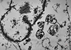 F,49y. | purulent meningitis- meningococcal v.s.